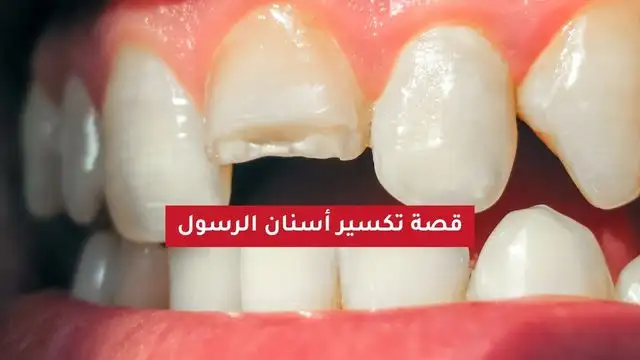 تكسير أسنان النبي